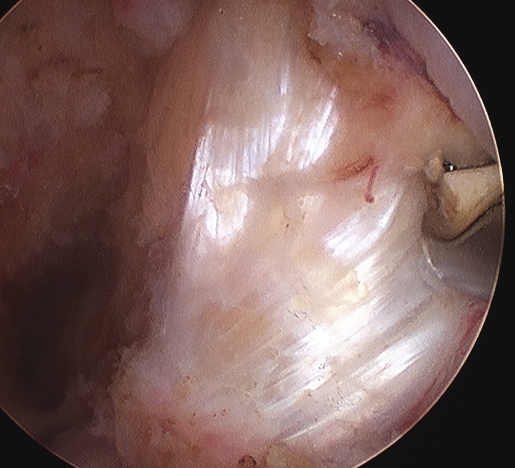 PCL Arthroscopy